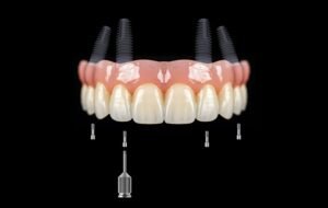 zirconium dental implants side effects