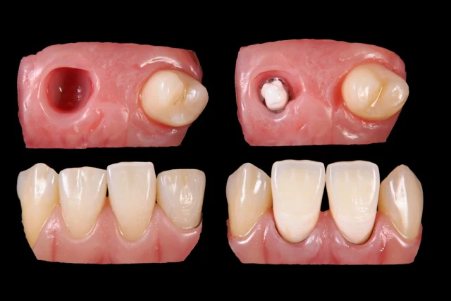 Regrow Adult Teeth: Best Natural and Affordable Methods