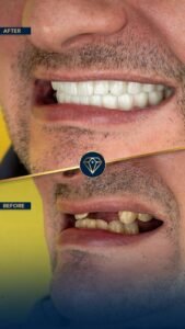 Hollywood Smile Turkey Price