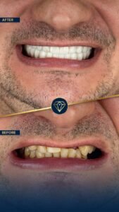 Smile makeover Turkey cost