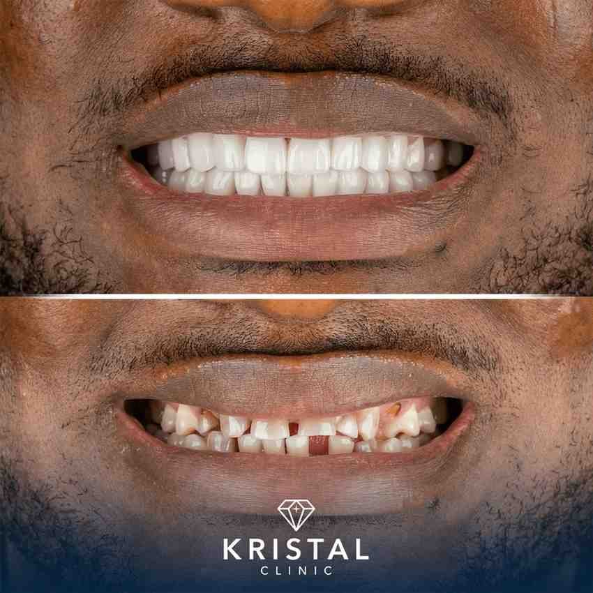hollywood smile turkey price