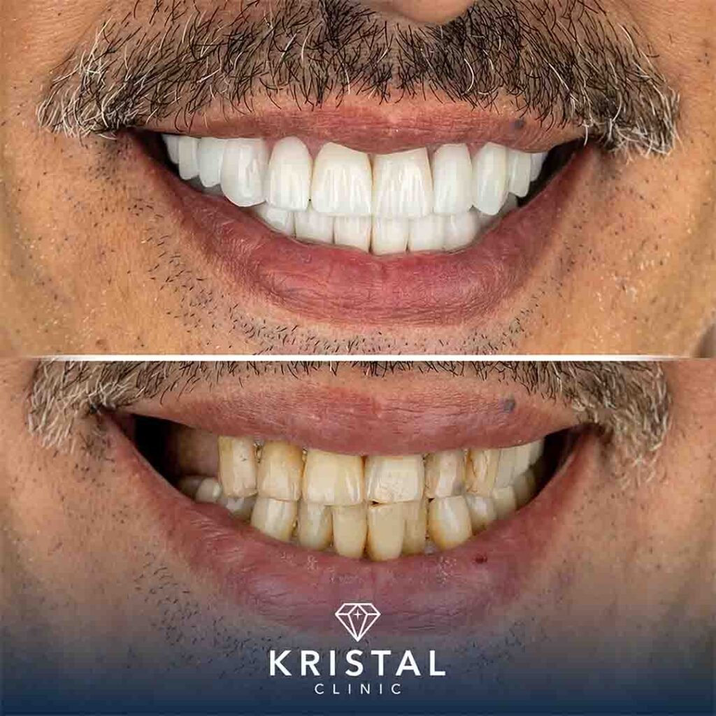 hollywood smile procedure