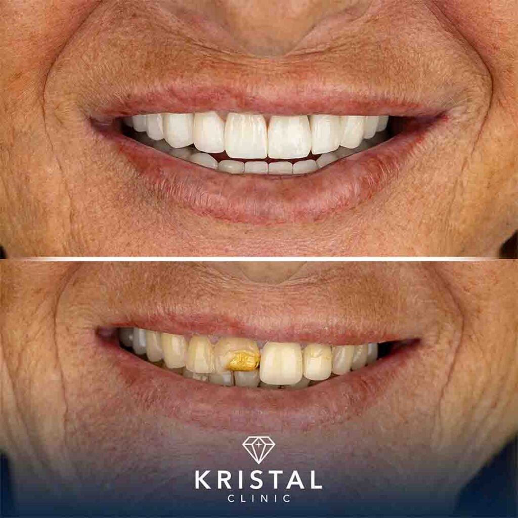 Is a Hollywood Smile Worth It