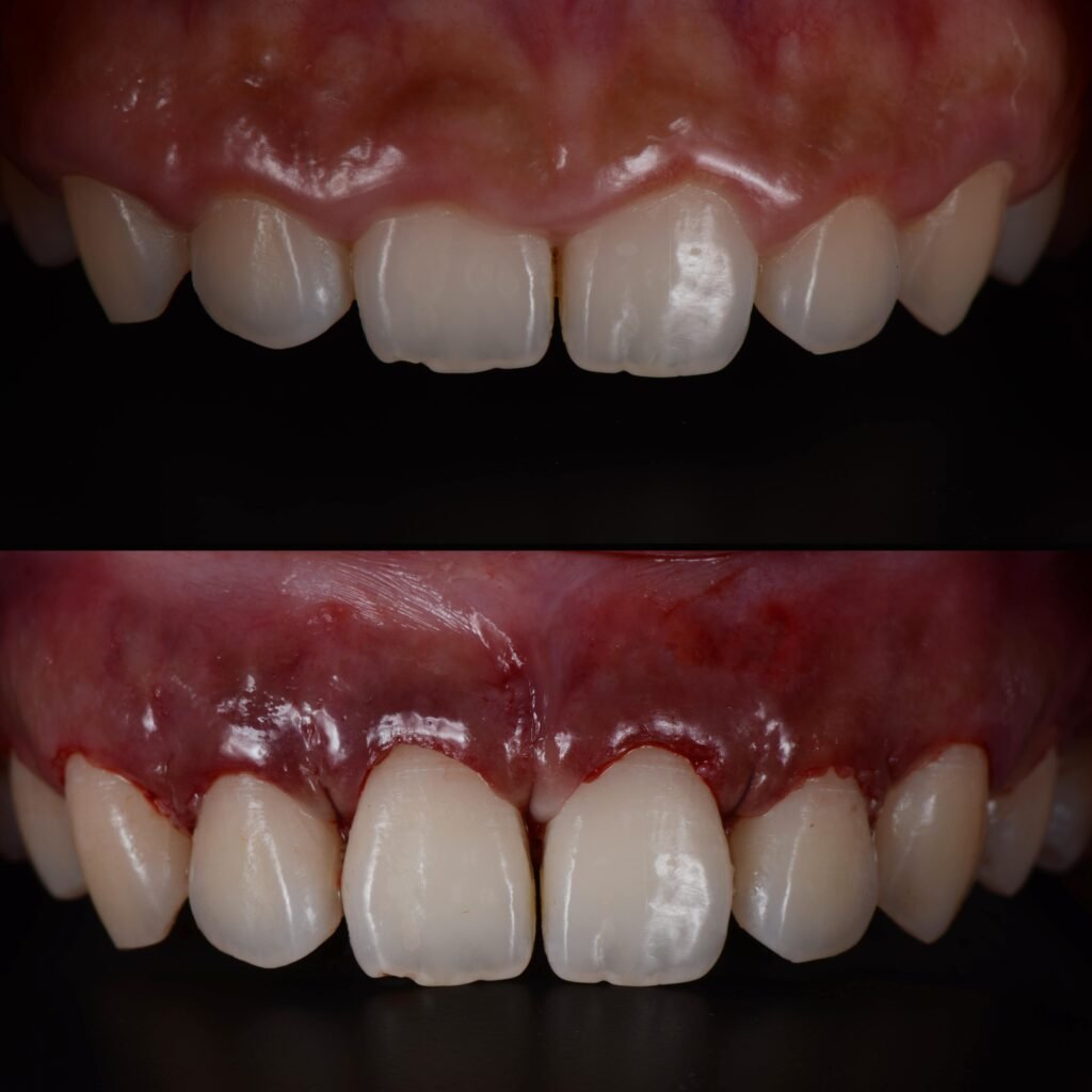 Hollywood Smile Procedure