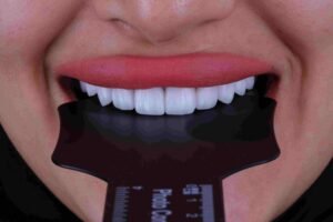 hollywood smile turkey price