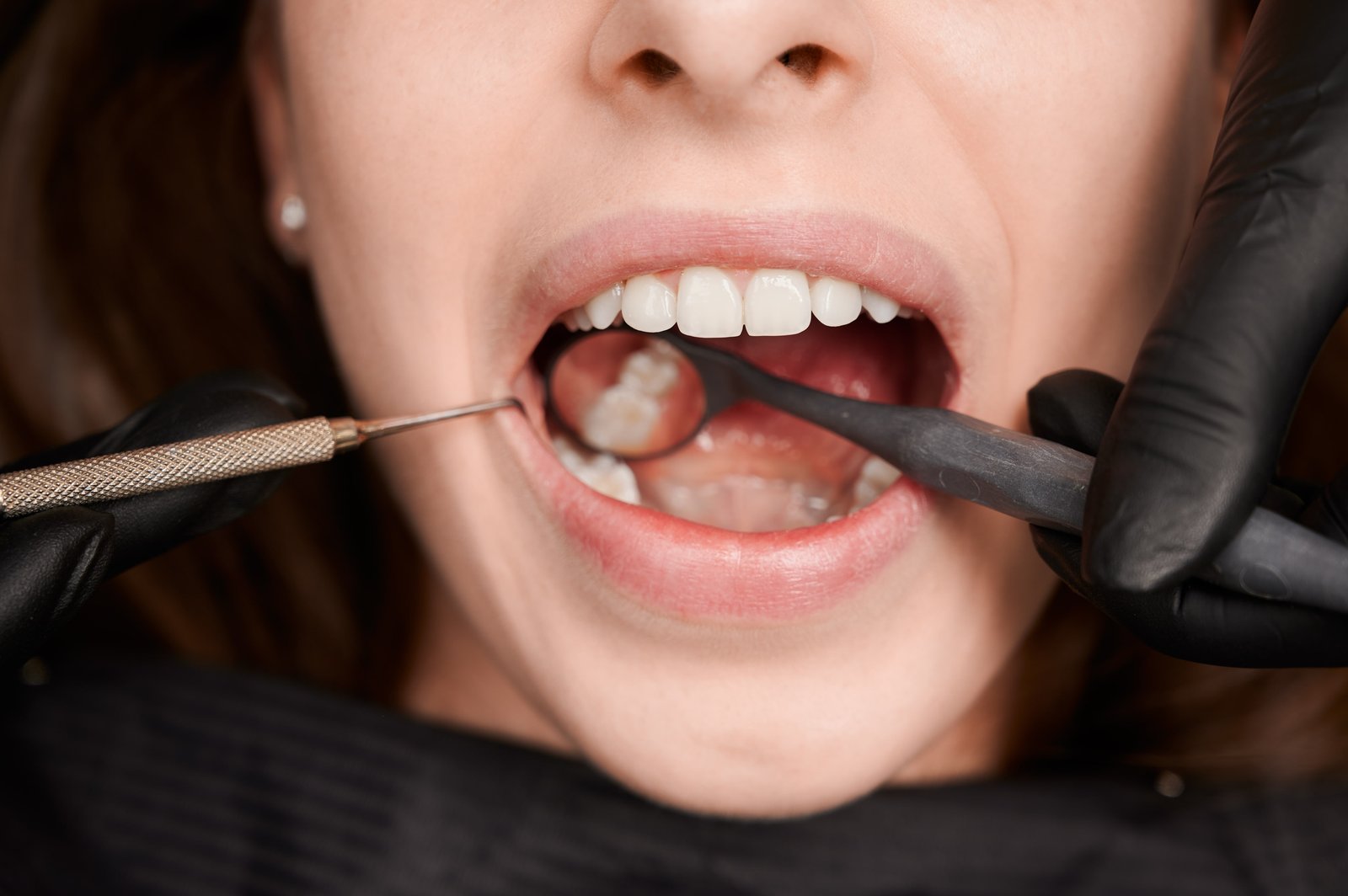 Dental Cement for Crowns: Best Crown Glue & Adhesive