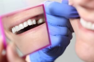 Dental Crowns Cost