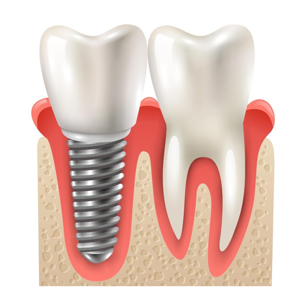 Dental Implant Parts