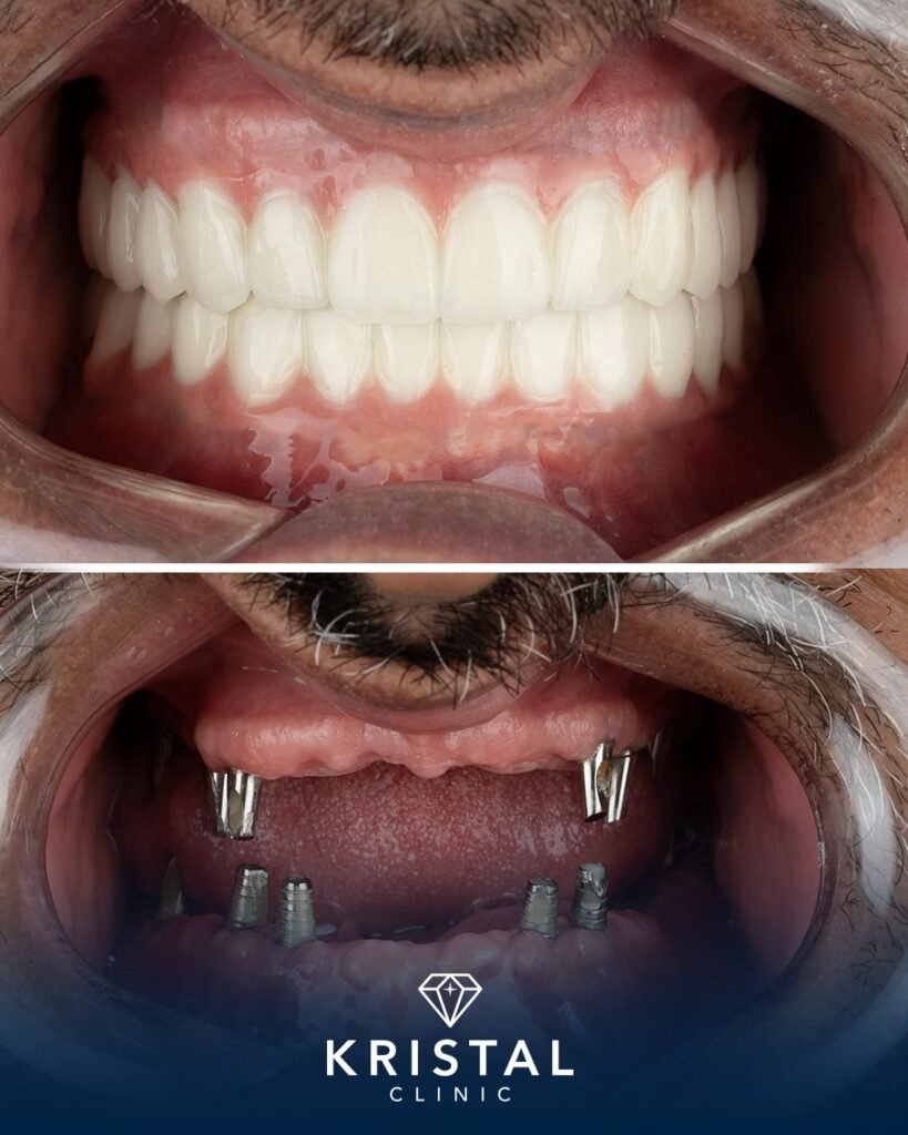 Bone Grafting for Dental Implants