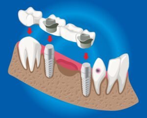 Multi-Unit Abutments