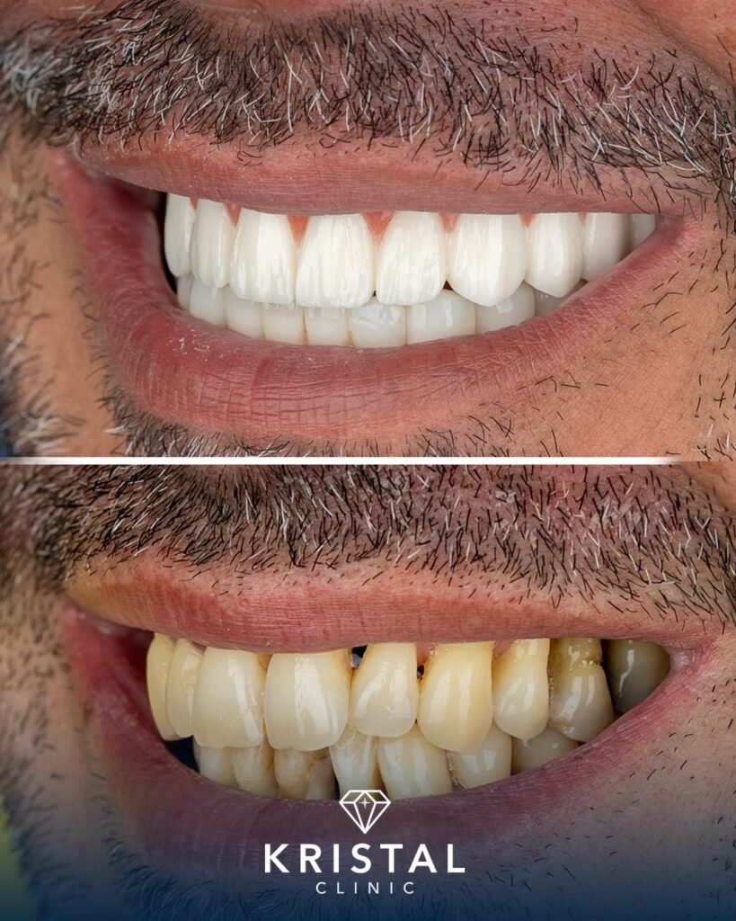 titanium vs zirconia dental implants