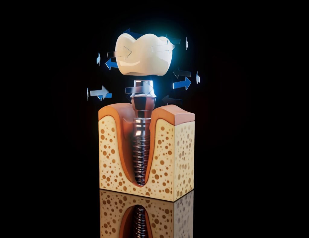 endosteal implant
