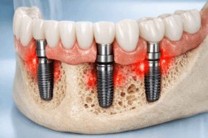 all on 4 dental implants problems